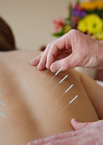 Dry Needling