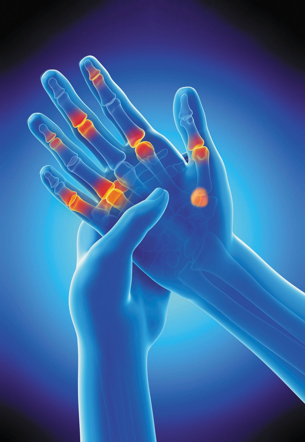 Arthritis